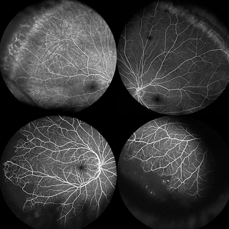 Babbar Hospital ANGIOGRAPHY