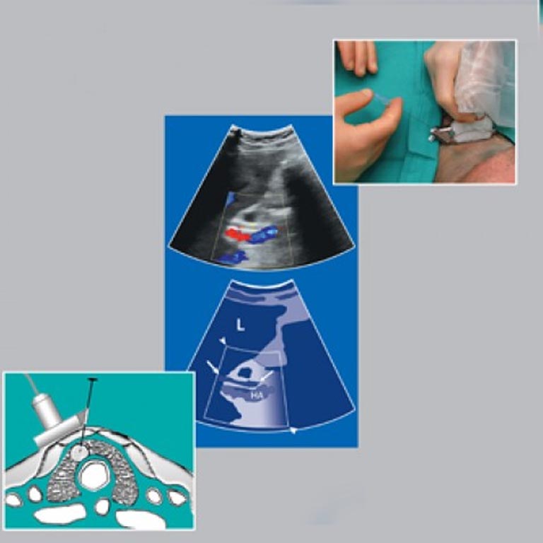 ULTRASOUND GUIDED PROCEDURES